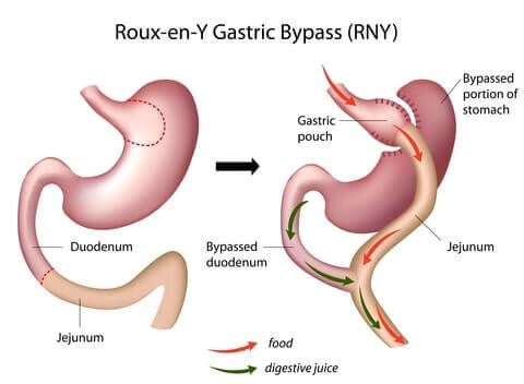 Bariatric Surgery in Iran , Weight Loss Surgery in Iran