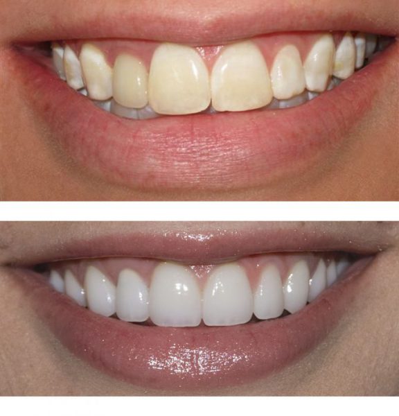 Marielaina Perrone DDS Las Vegas Porcelain Veneers 2 e1598098179417