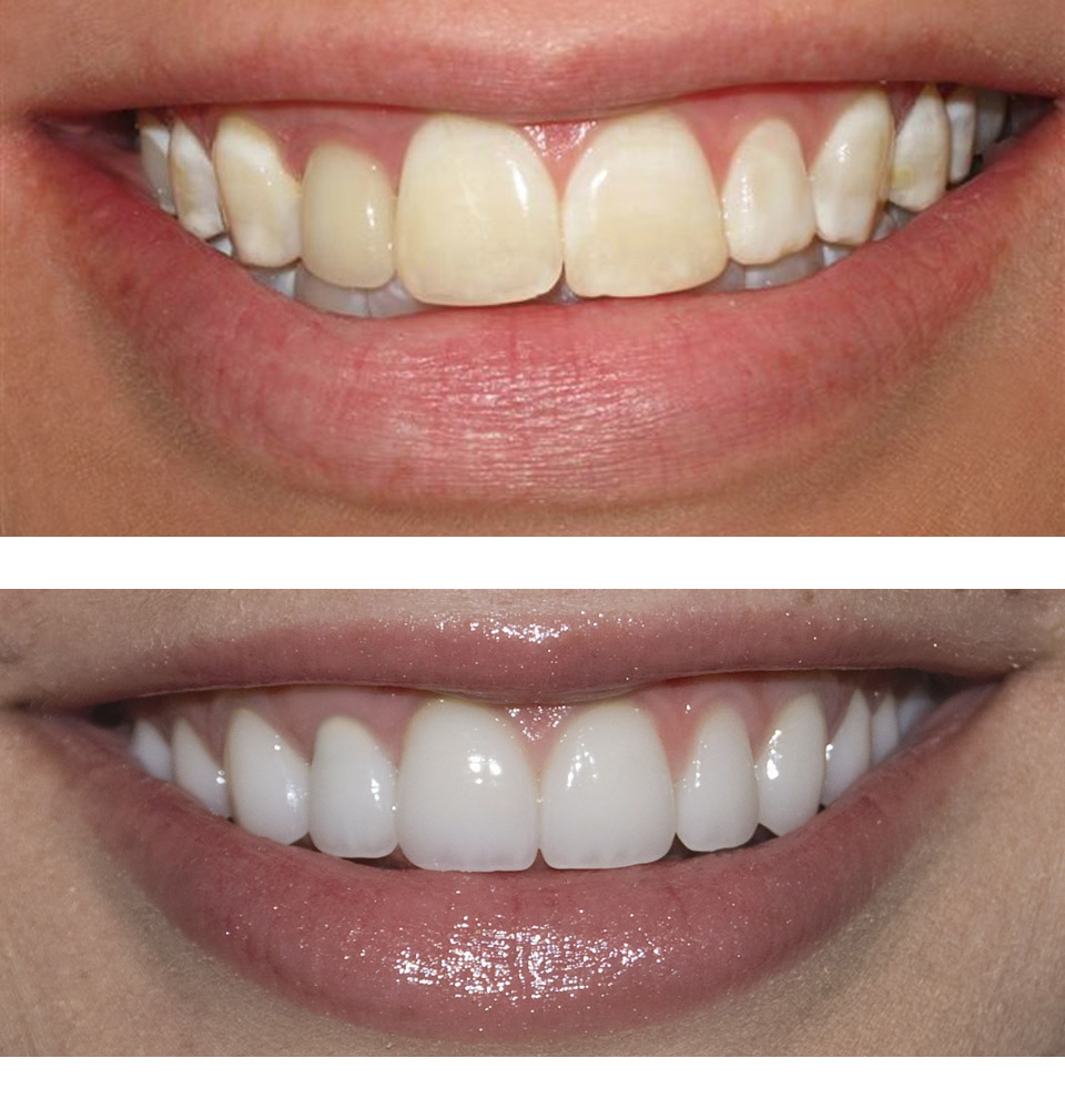 marielaina-perrone-dds-las-vegas-porcelain-veneers-2