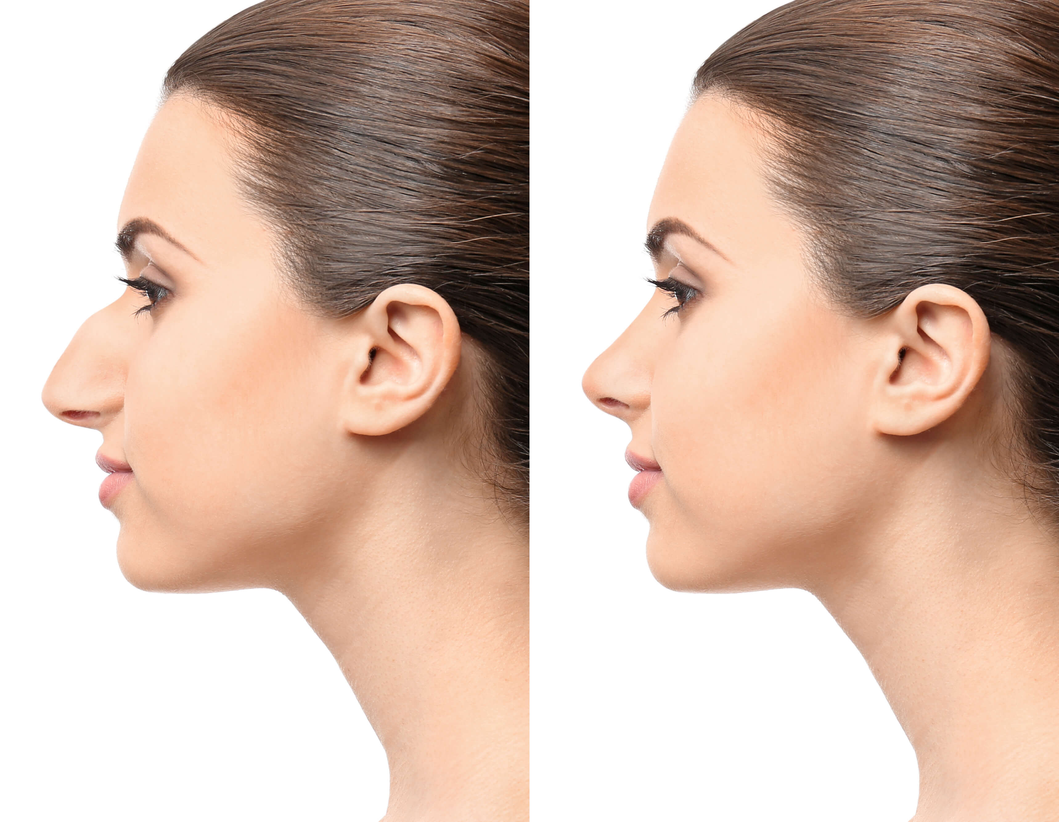 rhinoplasty-before-after