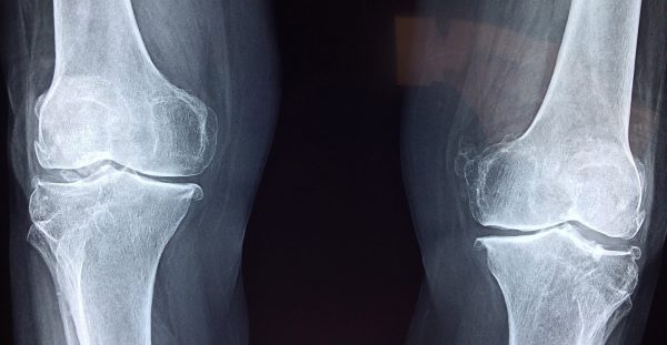 Knee replacement