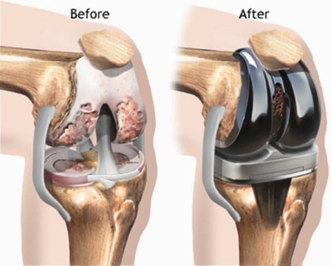 Knee replacement surgery