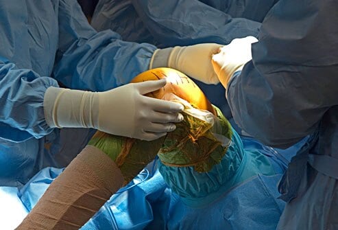 Knee replacement surgery