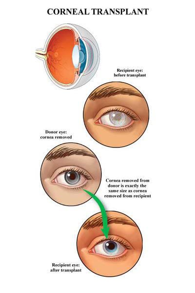 corneal transplant