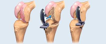 Knee replacement surgery