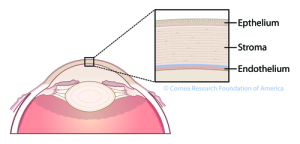 Corneal Transplant