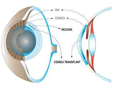 Corneal Transplant