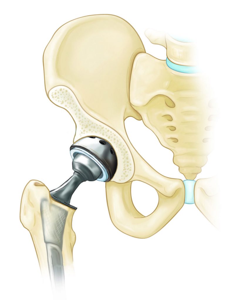 Hip replacement in Iran | Hip replacement cost | Hip replacement