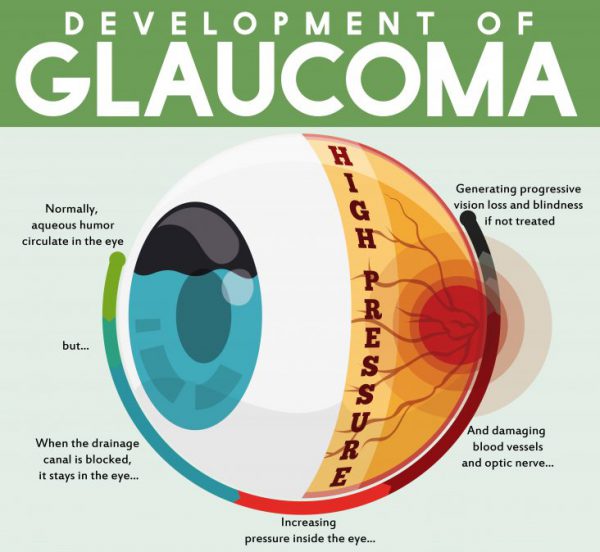 glaucoma surgery