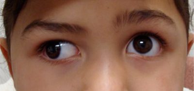 strabismus