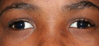 strabismus