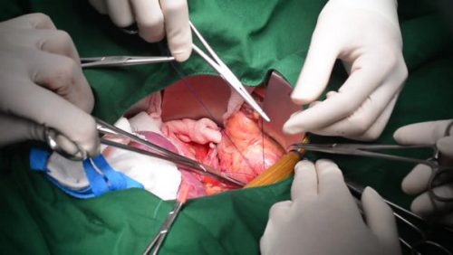 Kidney Transplant