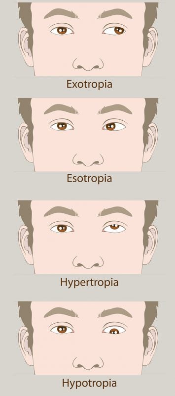 strabismus