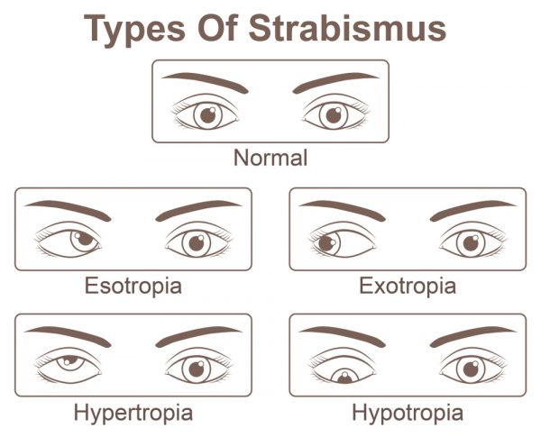 strabismus