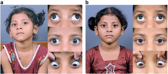 strabismus