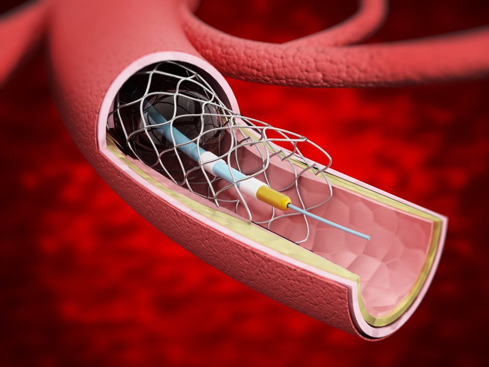 angioplasty