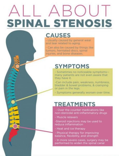 Spinal Stenosis causes, symptoms and treatment - Truspine