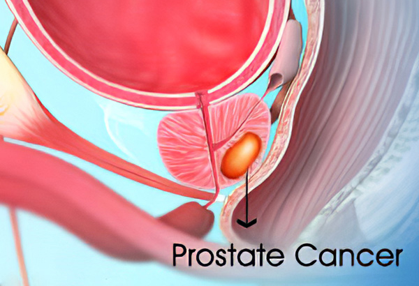 Prostate Cancer