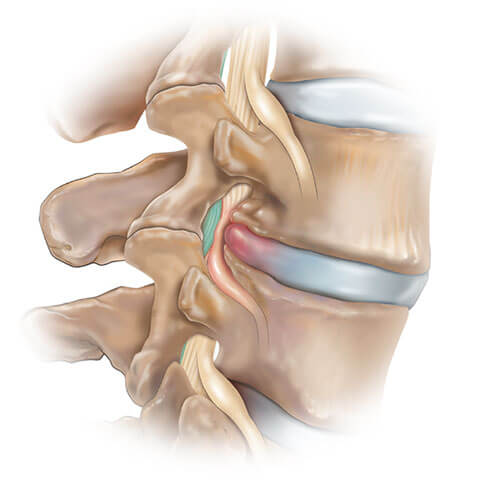 canal stenosis