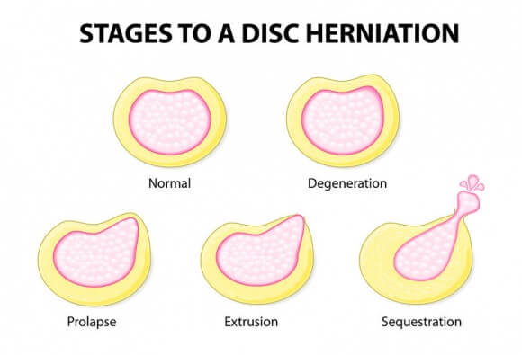 disc herniation surgery