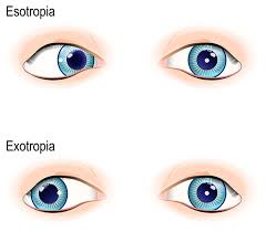 strabismus