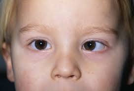 strabismus