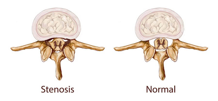 canal stenosis