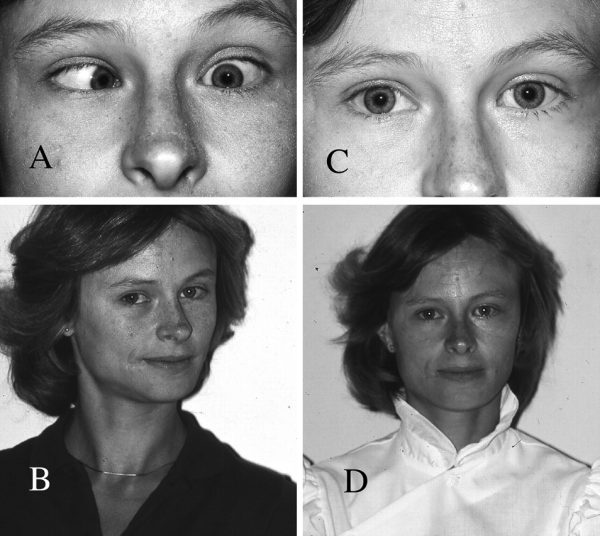 strabismus