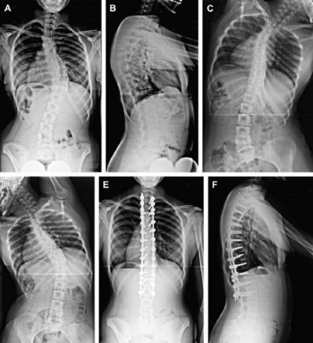 Spinal stenosis