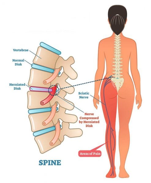 Spinal stenosis