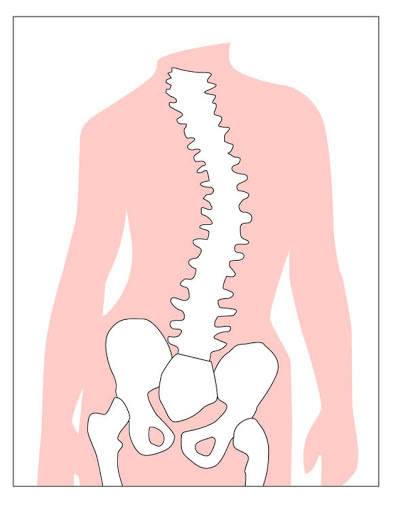 Spinal stenosis
