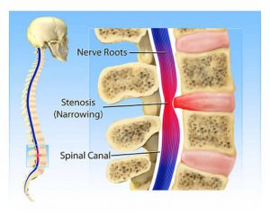 canal stenosis
