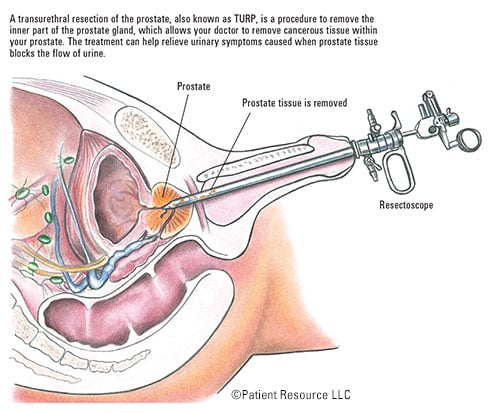 prostate cancer