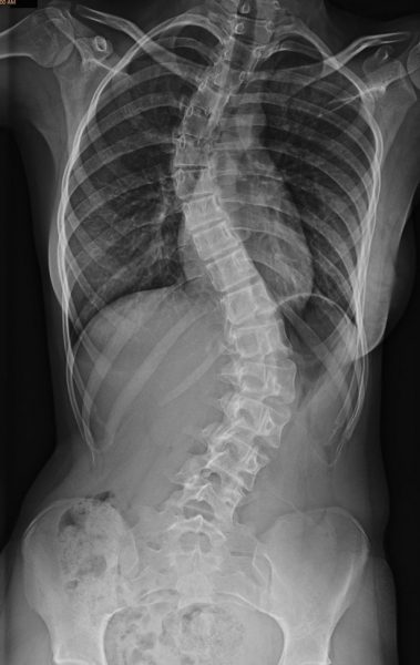 Spinal stenosis