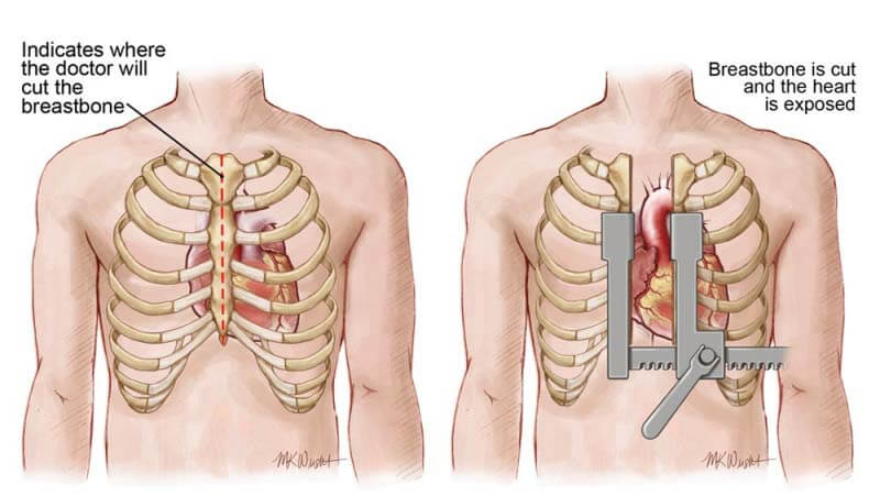 Open heart surgery (CABG)