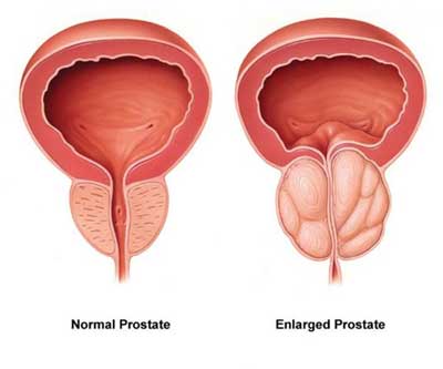 BPH Enlarged Prostate 400