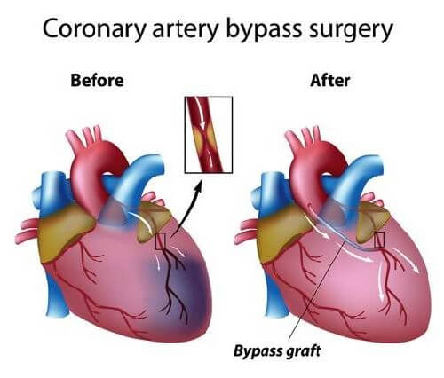 open heart surgery