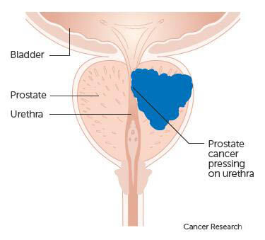 prostate TURP