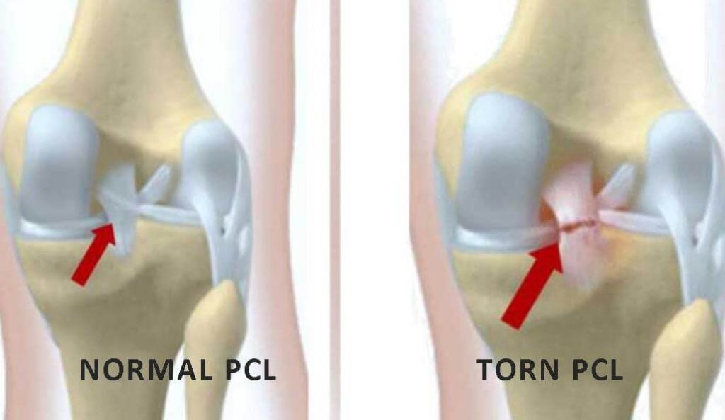 acl pcl