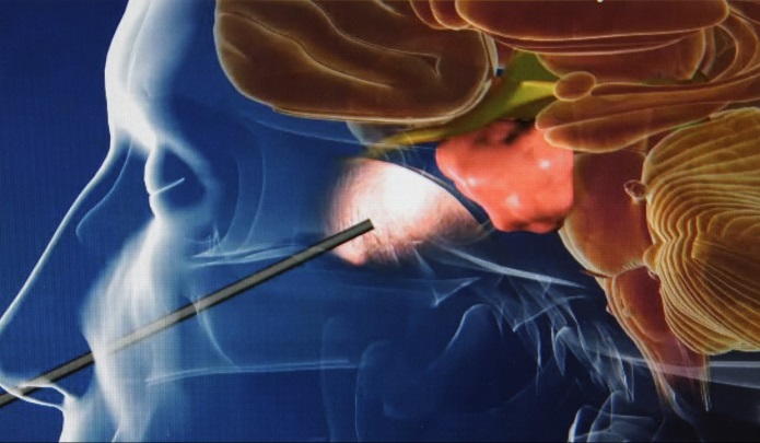 Endoscopic brain surgery