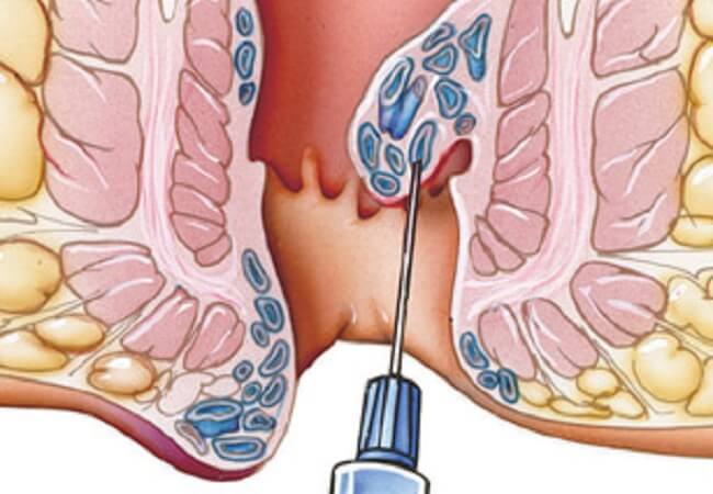 Hemorrhoids removal and anal fissures