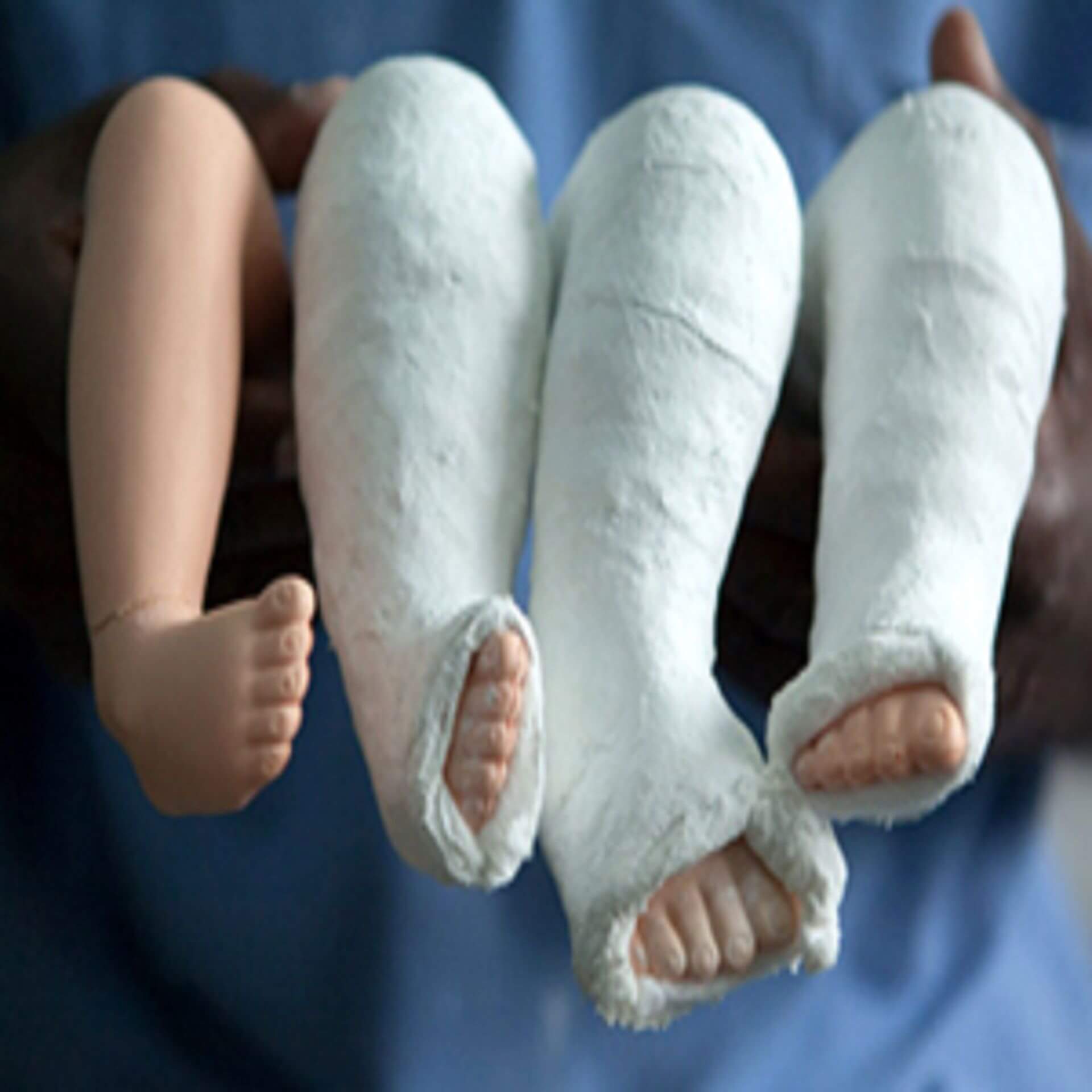 Clubfoot Treatment In Iran Best Doctors Clinics Free Consultation