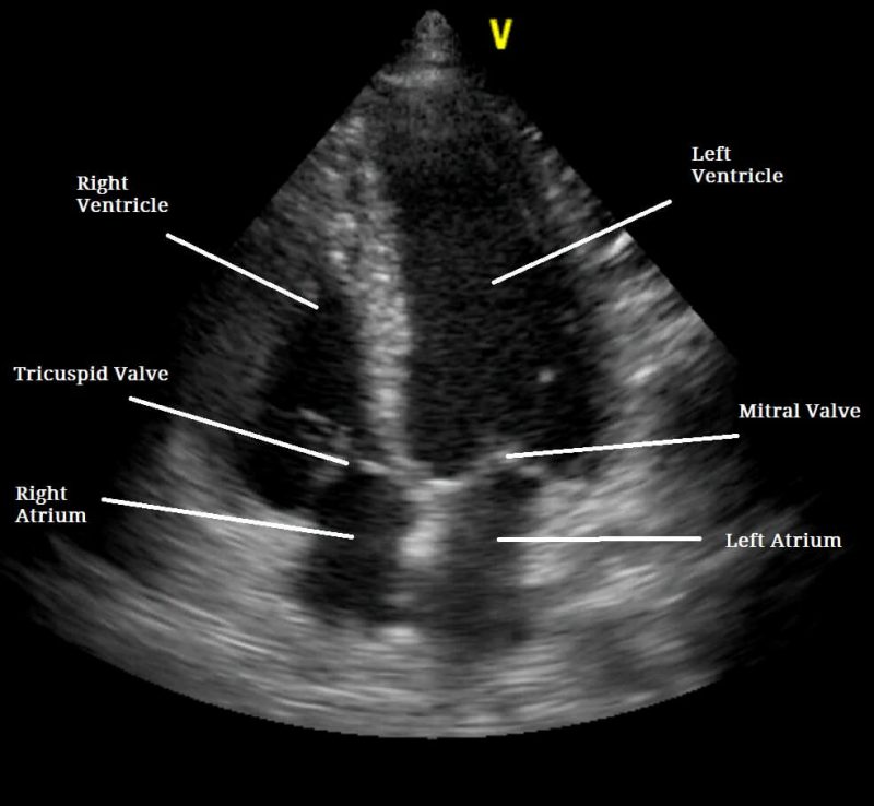 echocardiography