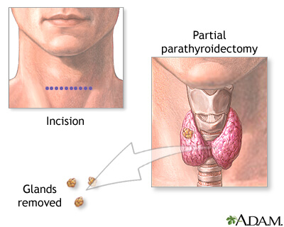 Thyroidectomy