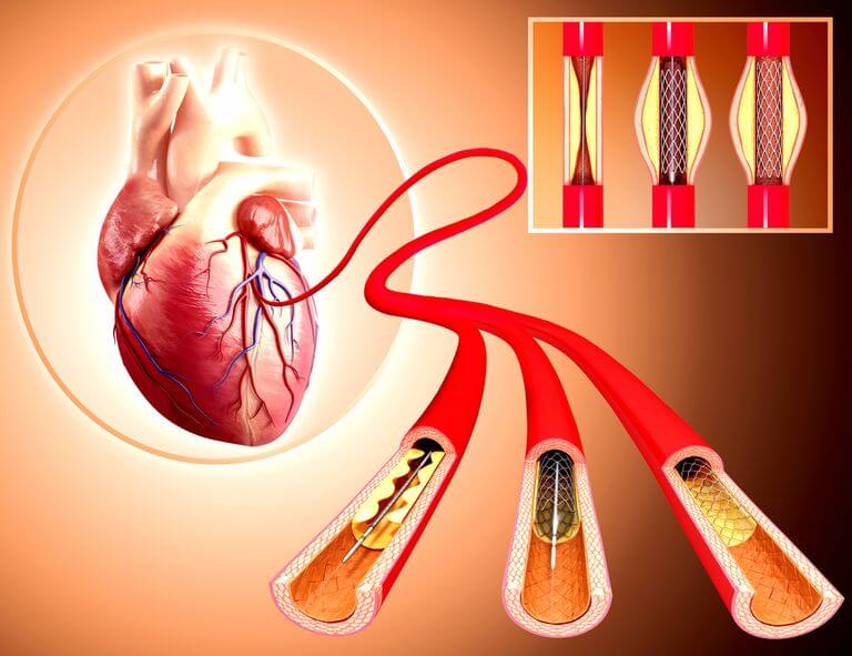 PCI stents