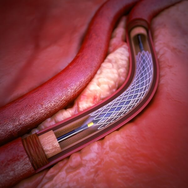 PCI stents