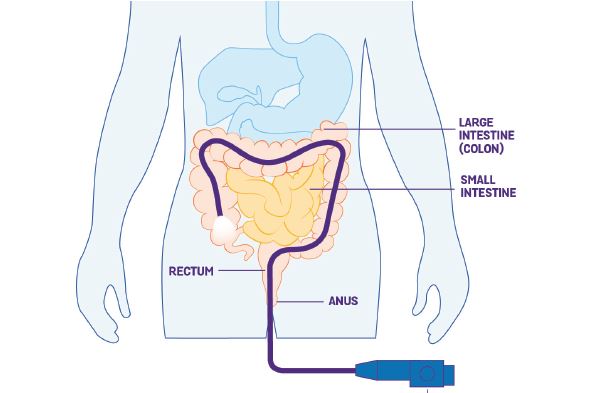 colonoscopy