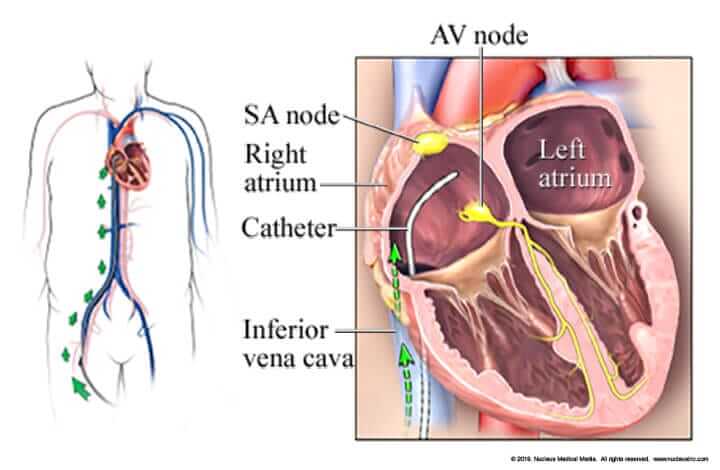 eps-and-catheter-ablation