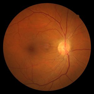 retinopathy