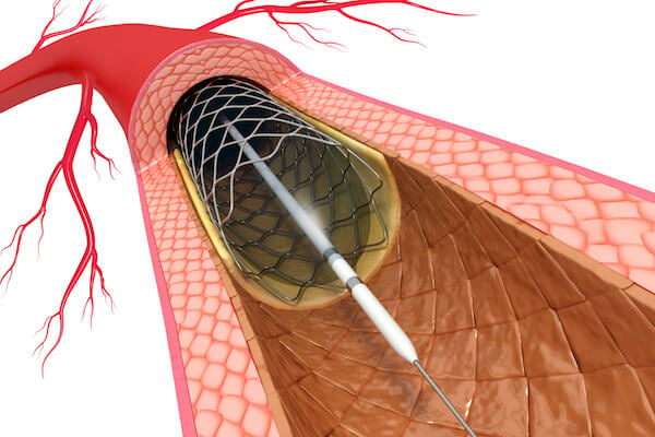 PCI stents